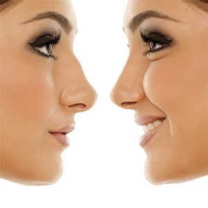 nose job package